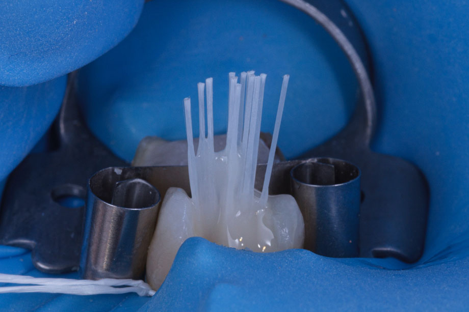 La dentisterie adhésive de la dent dépulpée : comment gérer efficacement la restauration de la dent dépulpée ?